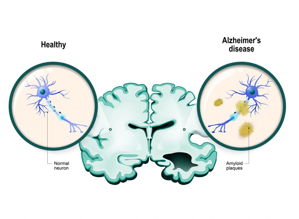 Alzheimer's disease. Neurons and brain